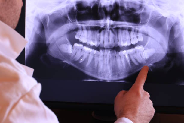 Best Emergency Tooth Extraction in Roswell, GA