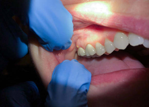 Best Emergency Denture Repair in Roswell, GA